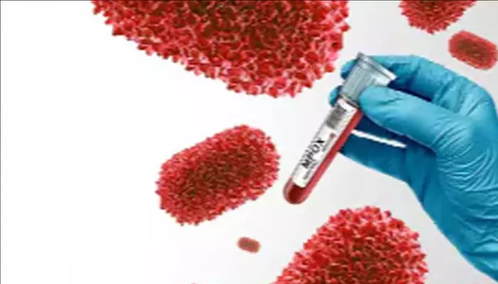 മലപ്പുറത്ത് ചാത്തല്ലൂര് സ്വദേശിക്ക് സ്ഥിരീകരിച്ചത് എം പോക്സ് ക്ലേഡ് വണ് ബി; ഇന്ത്യയില് സ്ഥിരീകരിക്കുന്നത് ആദ്യം മലപ്പുറത്ത് ചാത്തല്ലൂര് സ്വദേശിക്ക് സ്ഥിരീകരിച്ചത് എം പോക്സ് ക്ലേഡ് വണ് ബി; ഇന്ത്യയില് സ്ഥിരീകരിക്കുന്നത് ആദ്യം