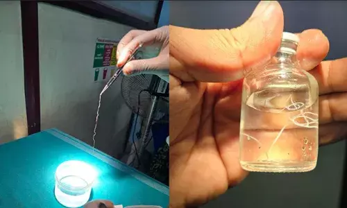 കണ്ണില്‍ അസഹ്യമായ ചൊറിച്ചില്‍; വിവിധ ആശുപത്രികള്‍ കയറിയിറങ്ങി; ഒടുവില്‍ 20കാരിയുടെ കണ്ണില്‍ നിന്ന് 16 സെ.മീ. നീളമുള്ള  ജീവനുള്ള വിരയെ കണ്ടെത്തി