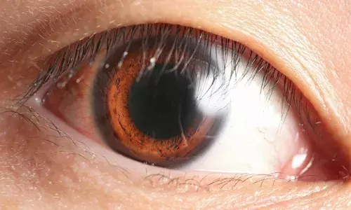 കണ്ണ് തിരുമല്ലേ; കാഴ്ച കുഴപ്പത്തിലാകാം: കണ്ണ് തിരുമ്മുന്നത് നേത്രപടലത്തിന്റെ ആകൃതിമാറ്റത്തിലേക്കും അന്ധതയിലേക്കും നയിക്കുമെന്ന് റിപ്പോര്‍ട്ട്