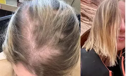 എല്ലാവരും കഴിക്കുന്ന ഈ മരുന്നുകള്‍ സ്ഥിരമായി ഉപയോഗിച്ചാല്‍ മുടി കൊഴിച്ചില്‍ ഉറപ്പ്; വിഷാദരോഗത്തിന്റെ മരുന്നുകളും മുഖക്കുരുവിന്റെ മരുന്നും മുടി കൊഴിക്കും