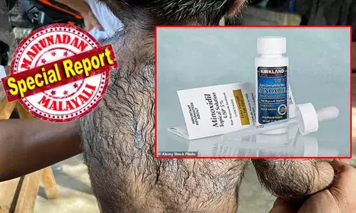 പണികിട്ടിയത് മുടി വളരാന്‍ മിനോക്സിഡില്‍ ഉപയോഗിച്ചവരുടെ കുഞ്ഞുങ്ങള്‍ക്ക്; ഈ മരുന്ന് ഉപയോഗിച്ചവര്‍ക്ക് കുഞ്ഞുങ്ങള്‍ ജനിക്കുമ്പോള്‍ ശരീരം മുഴുവന്‍ തിങ്ങി രോമങ്ങള്‍; വെര്‍വോള്‍ഫ് സിന്‍ഡ്രോമിന് കാരണം തേടിയപ്പോള്‍