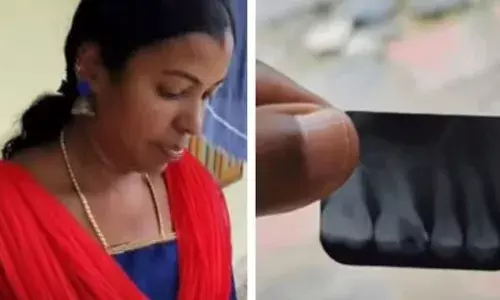 റൂട്ട്കനാൽ ചികിത്സക്കിടെ സൂചി ഒടിഞ്ഞ് പല്ലിനിടയിൽ കുടുങ്ങി; നെടുമങ്ങാട് ജില്ല ആശുപത്രിയിൽ ചികിത്സാപിഴവ് സംഭവിച്ചെന്ന് വീട്ടമ്മയുടെ പരാതി; സൂചി നീക്കം ചെയ്യാന്‍ നിർദ്ദേശിച്ചിരുന്നുവെന്ന് ആശുപത്രി അധികൃതർ