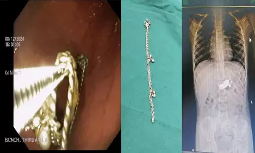 നാലു വയസുകാരി അബദ്ധത്തില്‍ പാദസരം വിഴുങ്ങി: ചെറുകുടലില്‍ തറച്ചിരുന്ന വെള്ളി പാദസരം ശസ്ത്രക്രിയ കൂടാതെ ബിലീവേഴ്‌സ് ചര്‍ച്ച് മെഡിക്കല്‍ കോളജിലെ ഡോക്ടര്‍ പുറത്തെടുത്തു