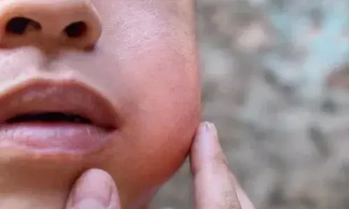 സംസ്ഥാനത്ത് മുണ്ടിനീര് ബാധിതരുടെ എണ്ണം 7000 കടന്നു; എംഎംആര്‍ വാക്‌സീന്‍ അനുവദിക്കണമെന്ന് കേന്ദ്രത്തോട് ആവശ്യപ്പെട്ട് കേരളം