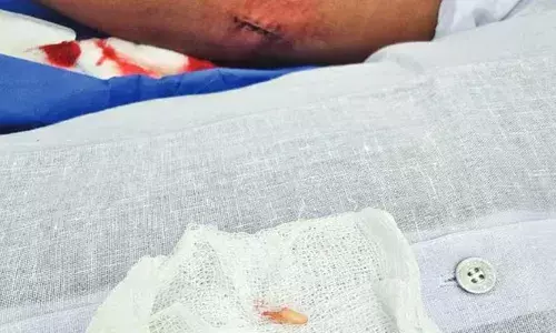 വീട്ടുമാറാത്ത കൈമുട്ട് വേദനയ്ക്ക് ശസ്ത്രക്രിയ; 36കാരന്റെ കൈയ്യില്‍ നിന്നും കിട്ടിയത് 25 വര്‍ഷം മുമ്പ് കടിച്ച പട്ടിയുടെ പല്ല്: കൂര്‍ത്തപല്ലിന്റെ പകുതിയോളം കിട്ടിയത് മുട്ടില്‍ തൊലിയോടു ചേര്‍ന്ന ഭാഗത്ത് നിന്നും