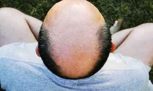 ബുല്‍ഡാനയിലെ ഗ്രാമങ്ങളില്‍ മുടികൊഴിച്ചില്‍ വ്യാപകം; ഒരാഴ്ചയ്ക്കിടെ കഷണ്ടിയായത് ഒട്ടേറെപ്പേര്‍; വെള്ളത്തില്‍ രാസവളം കലര്‍ന്നത് മൂലമെന്ന് സംശയം