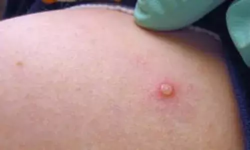 ലണ്ടനില്‍ കുരങ്ങുപനി കണ്ടെത്തി; ഉഗാണ്ടയില്‍ നിന്നും മടങ്ങിയെത്തിയ വ്യക്തി