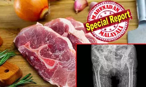 മാംസാഹാരം ശരിക്കും പാകം  ചെയ്ത് കഴിക്കുക! അല്ലെങ്കില്‍ നിങ്ങളുടെ ശരീരം വിരകളുടെ പ്രജനന കേന്ദ്രമായി മാറും; ഫ്‌ളോറിഡയിലെ രോഗിയുടെ എക്സ്റേ പരിശോധയില്‍ കണ്ടെത്തിയത് ശരീരമാകെ നാടന്‍ വിരകളുടെ മുട്ടകള്‍