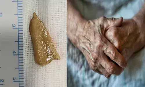 ബീഫ് കറി കൂട്ടി അത്താഴം കഴിച്ചതിന് ശേഷം അസ്വസ്ഥത; ചുമയും ശ്വാസമുട്ടലും മാറുന്നില്ല; സ്കാനിങ്ങിൽ കല്ലുപോലെയൊരു വസ്തു; പരിശോധനയിൽ ഡോക്ടർമാർ കണ്ടത് ഞെട്ടിപ്പിച്ചു; വയോധിക രക്ഷപ്പെട്ടത് തലനാരിഴയ്ക്ക്