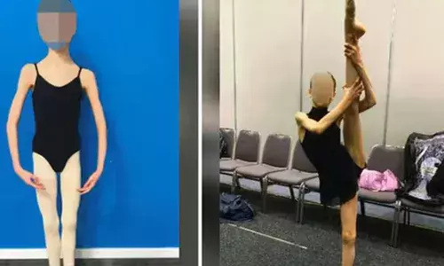 ചലിക്കുന്ന അസ്ഥികൂടം പോലൊരു പെണ്‍കുട്ടി; കടുത്ത ഭക്ഷണക്രമവും കഠിനമായ നൃത്തപരിശീലനവും മൂലം എല്ലും തോലുമായി 17കാരി:  കൊച്ചു കുഞ്ഞിനെ പോലെ തോന്നുന്ന കൗമാരക്കാരിയുടെ ചിത്രങ്ങള്‍ പുറത്ത്: മാതാപിതാക്കള്‍ക്ക് ജയില്‍