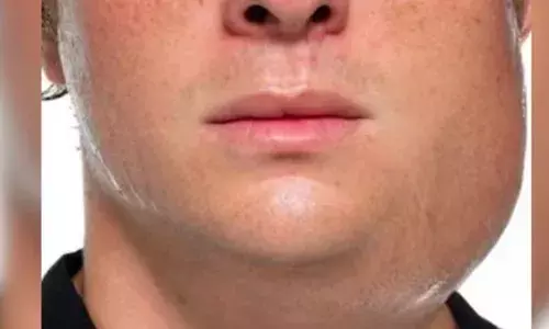 ചൂട് കൂടിയതോടെ മുണ്ടുനീര് ബാധിതരുടെ എണ്ണം വര്‍ധിക്കുന്നു; ഒന്നര മാസത്തിനിടെ ചികിത്സ തേടിയത് 9,763 പേര്‍