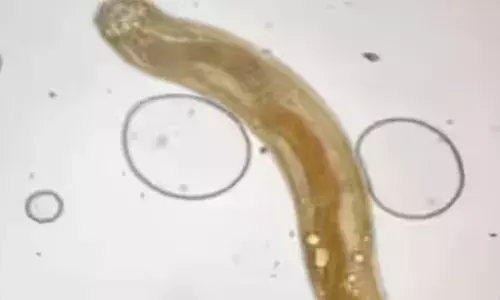 കാഴ്ച എപ്പോഴും മങ്ങുന്നു; പല മരുന്ന് കഴിച്ചിട്ടും ഫലമില്ല; ഡോക്ടർമാരുടെ പരിശോധനയിൽ കണ്ടെത്തിയത്; 35കാരന്‍റെ കണ്ണിൽ നിന്ന് ജീവനുള്ള വിരയെ പുറത്തെടുത്തു; ഞെട്ടൽ മാറാതെ കുടുംബം!