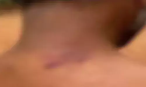 പാടത്ത് ജോലിക്കിടെ കർഷകന് സൂര്യാഘാതമേറ്റു; പൊള്ളലേറ്റത് കഴുത്തിൽ; ആശുപത്രിയിൽ ചികിത്സ തേടി; സംഭവം കോഴിക്കോട് കാരശ്ശേരിയിൽ