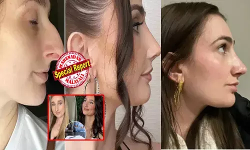 ലക്ഷങ്ങൾ മുടക്കി മൂക്കിന്റെ വളവ് ശരിയാക്കി; ഇപ്പൊ..ഞാന്‍ കൂടുതല്‍ സെക്സിയായതായി തോന്നുന്നു; എന്റെ ആത്മവിശ്വസം ഇരട്ടിച്ചു; ഇൻസ്റ്റ സ്റ്റോറിയിൽ തുള്ളിച്ചാടി യുവതി; ഇതോടെ വിവാഹ ബന്ധം വേർപ്പെടുത്തിയെന്നും വെളിപ്പെടുത്തൽ; ഇതും ഞങ്ങൾ അതിജീവിക്കുമെന്ന് സോഷ്യൽ ലോകം!