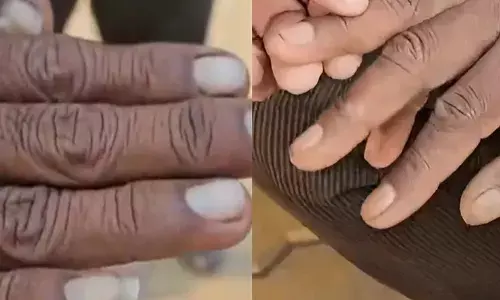 മുടി കൊഴിച്ചിലിന് പിന്നാലെ ബുള്‍ഡാന നിവാസികളുടെ നഖം കൊഴിയുന്നു; ഇതുവരെ കൊഴിഞ്ഞത് 39 പേരുടെ നഖം: അപൂര്‍വരോഗം റിപ്പോര്‍ട്ട് ചെയ്തത് അഞ്ച് ഗ്രാമങ്ങളില്‍