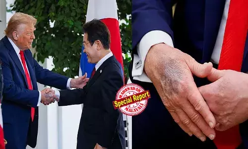 കനത്ത മേക്കപ്പിനും മറയ്ക്കാനാകുന്നില്ല! ട്രംപിന്റെ വലംകയ്യില്‍ ഇരുണ്ട നീല നിറത്തിലുളള ചതവിന്റെ പാടുകള്‍; നിരന്തരം ലോക നേതാക്കള്‍ക്ക് കൈ കൊടുക്കുന്നതും ആസ്പിരിന്‍ ഉപയോഗിക്കുന്നതും കാരണമെന്ന് വൈറ്റ് ഹൗസ് പ്രസ് സെക്രട്ടറി; യുഎസ് പ്രസിഡന്റിന്റെ ആരോഗ്യനിലയില്‍ ആശങ്കയേറുന്നു