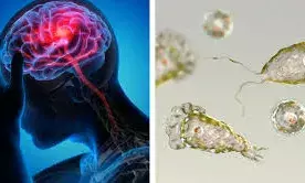 ഒരാള്‍ക്ക് കൂടി അമീബിക് മസ്തിഷ്‌ക ജ്വരം; സ്ഥിരീകരിച്ചത് കോഴിക്കോട് മെഡിക്കല്‍ കോളജില്‍ ചികിത്സയിലുള്ള മലപ്പുറം സ്വദേശിയായ പത്തുവയസുകാരന്