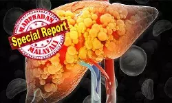 50 വര്ഷത്തിനിടെ മരണനിരക്ക് നാലിരട്ടിയായി വര്ദ്ധിച്ചു; കരള് രോഗത്തെ ശ്രദ്ധിക്കണം; പ്രധാന കാരണം കണ്ടെത്തി ശാസ്ത്രജ്ഞര് 50 വര്ഷത്തിനിടെ മരണനിരക്ക് നാലിരട്ടിയായി വര്ദ്ധിച്ചു; കരള് രോഗത്തെ ശ്രദ്ധിക്കണം; പ്രധാന കാരണം കണ്ടെത്തി ശാസ്ത്രജ്ഞര്