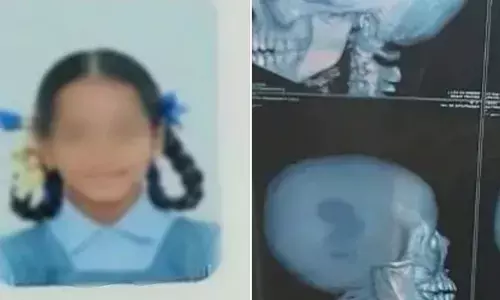 ക്ലാസ്സിൽ അച്ചടക്ക ലംഘനം കാണിച്ചെന്ന പേരിൽ അധ്യാപികയുടെ ക്രൂരത; ബാഗ് കൊണ്ടുള്ള അടിയേറ്റ് ആറാം ക്ലാസുകാരിയുടെ തലയോട്ടിക്ക് പൊട്ടൽ; വ്യാപക പ്രതിഷേധം