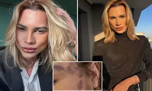 കോസ്മെറ്റിക് സർജറിയെ തുടർന്ന് അണുബാധ; മരുന്നിന് പോലും രക്ഷിക്കാൻ കഴിഞ്ഞില്ല; ഒടുവിൽ ബ്രസീലിലെ ഇൻഫ്ലുവൻസർക്ക് ദാരുണാന്ത്യം