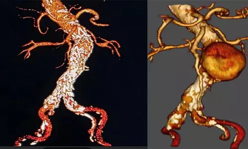 അടൂര്‍ ലൈഫ് ലൈനില്‍ ഇവിഎആര്‍ ചികിത്സ വിജയകരം; അയോര്‍ട്ട ധമനി പൊട്ടാതെ സ്റ്റെന്റ് ഘടിപ്പിച്ചത് കാര്‍ഡിയോളജി-കാര്‍ഡിയാക് സര്‍ജറി വിഭാഗം