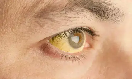 കാളികാവിൽ മഞ്ഞപ്പിത്തം പടരുന്നു; ഒരു കിലോമീറ്റർ ചുറ്റളവിൽ രോഗം സ്ഥിരീകരിച്ചത് എട്ടു കുട്ടികളടക്കം ഒമ്പത് പേർക്ക്; രോഗവ്യാപനത്തിന്‍റെ ഉറവിടം വ്യക്തമല്ല; കിണറുകളിലെ വെള്ളം പരിശോധനയ്ക്ക് അയച്ചു