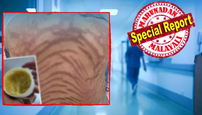 ഓൺലൈനിൽ വാങ്ങിയ സ്കിൻ ക്രീം ഉപയോഗിച്ച യുവതിക്ക് ഗുരുതര ആരോഗ്യപ്രശ്നങ്ങൾ; ശരീരത്തിൽ പ്രത്യക്ഷപ്പെട്ടത് പാമ്പുകളുടെ ചർമ്മത്തിന് സമാനമായ വരകൾ; ചൈനീസ് പരമ്പരാഗത മരുന്ന് എന്ന പേരിൽ വിറ്റിരുന്ന ക്രീമിനായി ചെലവാക്കിയത് 12 ലക്ഷത്തിലേറെ; കാരണം കണ്ടെത്തി ഡോക്ടർമാർ ഓൺലൈനിൽ വാങ്ങിയ സ്കിൻ ക്രീം ഉപയോഗിച്ച യുവതിക്ക് ഗുരുതര ആരോഗ്യപ്രശ്നങ്ങൾ; ശരീരത്തിൽ പ്രത്യക്ഷപ്പെട്ടത് പാമ്പുകളുടെ ചർമ്മത്തിന് സമാനമായ വരകൾ; ചൈനീസ് പരമ്പരാഗത മരുന്ന് എന്ന പേരിൽ വിറ്റിരുന്ന ക്രീമിനായി ചെലവാക്കിയത് 12 ലക്ഷത്തിലേറെ; കാരണം കണ്ടെത്തി ഡോക്ടർമാർ