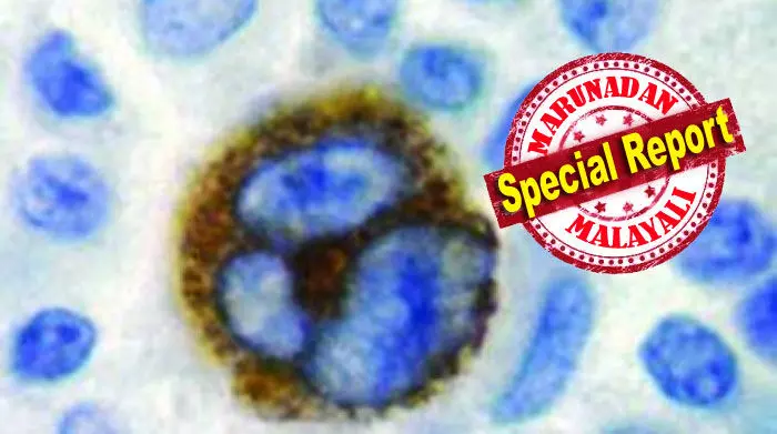 ഉമിനീരിലൂടെ പടരുന്ന ചുംബന രോഗം; ലോകജനസംഖ്യയുടെ 95% പേരെയും ബാധിക്കുന്ന വൈറസ് വിനാശകരമായ ഓട്ടോ ഇമ്മ്യൂണ്‍ അവസ്ഥകള്‍ക്ക് കാരണമാകും; കരുതലെടുക്കാന്‍ ഇത്ാ ഒരു ആരോഗ്യ പഠന റിപ്പോര്‍ട്ട്