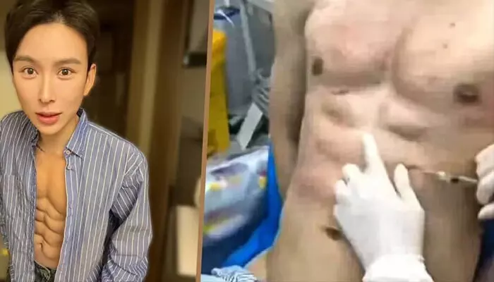 വ്യായാമമില്ലാതെ എയ്റ്റ് പാക്കിനായി കുത്തിവെക്കേണ്ടത് ഹൈലൂറോണിക് ആസിഡിന്റെ 10,000 ഡോസുകൾ; 40% പൂർത്തിയായെന്ന് കണ്ടന്റ് ക്രിയേറ്റർ; ചെലവാക്കിയത് 5 കോടിലധികം രൂപ; ലക്ഷ്യം ഗിന്നസ് റെക്കോർഡും