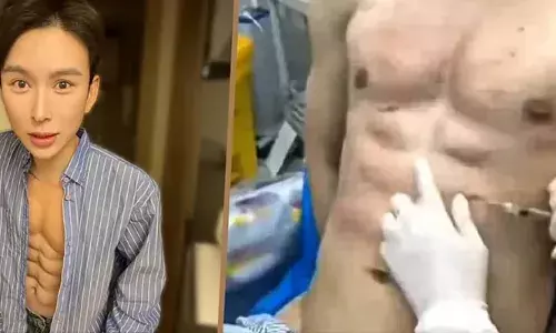 വ്യായാമമില്ലാതെ എയ്റ്റ് പാക്കിനായി കുത്തിവെക്കേണ്ടത് ഹൈലൂറോണിക് ആസിഡിന്റെ 10,000 ഡോസുകൾ; 40% പൂർത്തിയായെന്ന് കണ്ടന്റ് ക്രിയേറ്റർ; ചെലവാക്കിയത് 5 കോടിലധികം രൂപ; ലക്ഷ്യം ഗിന്നസ് റെക്കോർഡും