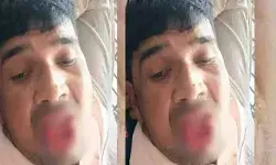 മുന്‍ കാമുകിയെ ബലംപ്രയോഗിച്ച് ചുംബിച്ചു; യുവാവിന്റെ നാക്കു കടിച്ച് മുറിച്ച് യുവതി