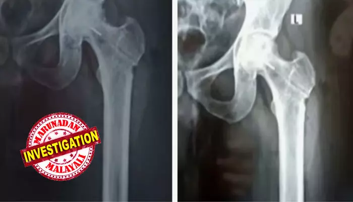 രക്തയോട്ടം കൂട്ടാനുള്ള ശസ്ത്രക്രിയക്കിടെ ഇടുപ്പെല്ലില് ഡ്രില് ബിറ്റ് ഒടിഞ്ഞു കയറി; തിരുവനന്തപുരം ജൂബിലി ആശുപത്രിക്കെതിരെ ചികിത്സ പിഴവെന്ന് പരാതി; കേസെടുത്ത് പൊലീസ് രക്തയോട്ടം കൂട്ടാനുള്ള ശസ്ത്രക്രിയക്കിടെ ഇടുപ്പെല്ലില് ഡ്രില് ബിറ്റ് ഒടിഞ്ഞു കയറി; തിരുവനന്തപുരം ജൂബിലി ആശുപത്രിക്കെതിരെ ചികിത്സ പിഴവെന്ന് പരാതി; കേസെടുത്ത് പൊലീസ്