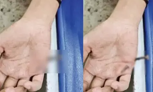 ക്രിക്കറ്റ് കളിക്കിടെ റണ്ണെടുക്കാൻ ബാറ്റുമായി ഓട്ടം; പെട്ടെന്ന് നില തെറ്റി കമഴ്ന്നടിച്ച് വീണതും വേദന കൊണ്ട് പുളഞ്ഞ് വിദ്യാർത്ഥി; കൈപ്പത്തിയിൽ ആണി തുളച്ചുകയറി പരിക്ക്