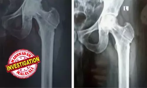 രക്തയോട്ടം കൂട്ടാനുള്ള ശസ്ത്രക്രിയക്കിടെ ഇടുപ്പെല്ലില് ഡ്രില് ബിറ്റ് ഒടിഞ്ഞു കയറി; തിരുവനന്തപുരം ജൂബിലി ആശുപത്രിക്കെതിരെ ചികിത്സ പിഴവെന്ന് പരാതി; കേസെടുത്ത് പൊലീസ് രക്തയോട്ടം കൂട്ടാനുള്ള ശസ്ത്രക്രിയക്കിടെ ഇടുപ്പെല്ലില് ഡ്രില് ബിറ്റ് ഒടിഞ്ഞു കയറി; തിരുവനന്തപുരം ജൂബിലി ആശുപത്രിക്കെതിരെ ചികിത്സ പിഴവെന്ന് പരാതി; കേസെടുത്ത് പൊലീസ്