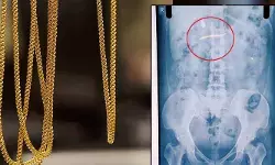 കുട്ടിയുടെ കഴുത്തില്‍ നിന്നും മോഷ്ടിച്ച സ്വര്‍ണമാല 35കാരി വിഴുങ്ങി; എക്‌സറേ പരിശോധനയില്‍ ആഭരണം വയറ്റിലുണ്ടെന്ന് കണ്ടെത്തല്‍:   തൊണ്ടിമുതല്‍ പുറത്ത് വരുന്നതും കാത്ത് യുവതിക്ക് പോലിസ് കാവല്‍