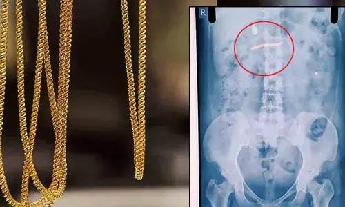 കുട്ടിയുടെ കഴുത്തില്‍ നിന്നും മോഷ്ടിച്ച സ്വര്‍ണമാല 35കാരി വിഴുങ്ങി; എക്‌സറേ പരിശോധനയില്‍ ആഭരണം വയറ്റിലുണ്ടെന്ന് കണ്ടെത്തല്‍:   തൊണ്ടിമുതല്‍ പുറത്ത് വരുന്നതും കാത്ത് യുവതിക്ക് പോലിസ് കാവല്‍