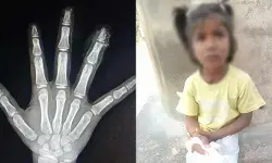 സ്‌കൂളിൽ വെച്ച് ആറുവയസ്സുകാരിയുടെ രണ്ട് വിരലുകൾ അറ്റു; മാതാപിതാക്കളെത്തിയപ്പോൾ കുട്ടി അബോധാവസ്ഥയിൽ; അറ്റ വിരലുകൾ വലിച്ചെറിഞ്ഞുവെന്ന് അധികൃതർ;  കേസെടുത്ത് പോലീസ്