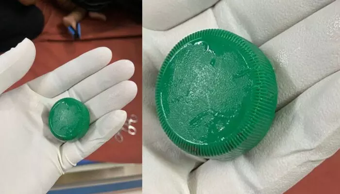 കളിക്കുന്നതിനിടെ പത്തു മാസം പ്രായമുള്ള കുട്ടിയുടെ തൊണ്ടയില് അടപ്പ് കുടുങ്ങി; ശ്വാസതടസം അനുഭവപ്പെട്ട കുട്ടിക്ക് രക്ഷകരായത് മെഡിക്കല് കോളേജിലെ ഡോക്ടര്മാര് കളിക്കുന്നതിനിടെ പത്തു മാസം പ്രായമുള്ള കുട്ടിയുടെ തൊണ്ടയില് അടപ്പ് കുടുങ്ങി; ശ്വാസതടസം അനുഭവപ്പെട്ട കുട്ടിക്ക് രക്ഷകരായത് മെഡിക്കല് കോളേജിലെ ഡോക്ടര്മാര്