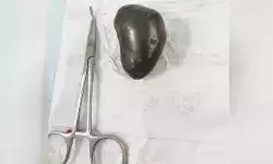 72 വയസ്സുള്ള രോഗിയുടെ വൃക്ക തുറന്ന് കല്ല് നീക്കി; പുറത്തെടുത്തത് നാലരസെന്റിമീറ്റര്‍ നീളവും മൂന്നര സെന്റിമീറ്റര്‍ വീതിയുമുള്ള കല്ല്