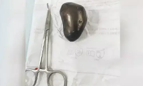 72 വയസ്സുള്ള രോഗിയുടെ വൃക്ക തുറന്ന് കല്ല് നീക്കി; പുറത്തെടുത്തത് നാലരസെന്റിമീറ്റര്‍ നീളവും മൂന്നര സെന്റിമീറ്റര്‍ വീതിയുമുള്ള കല്ല്