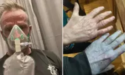 രാവിലെ ഉറക്കമുണർന്നപ്പോൾ തന്റെ കണ്ണുകൾക്ക് വിശ്വസിക്കാൻ പറ്റാത്ത ഒരു കാഴ്ച; നിമിഷ നേരം കൊണ്ട് ചർമ്മം നീല നിറമായി മാറി; പിന്നിലെ കാരണം ഞെട്ടിക്കുന്നത്