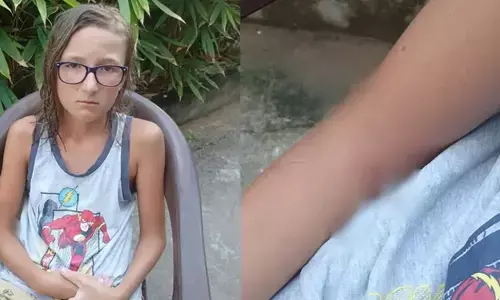 കോവളം ലൈറ്റ് ഹൗസ് ബീച്ചില്‍ റഷ്യന്‍ സ്വദേശിയായ 13-കാരന് തെരുവ് നായയുടെ കടിയേറ്റു