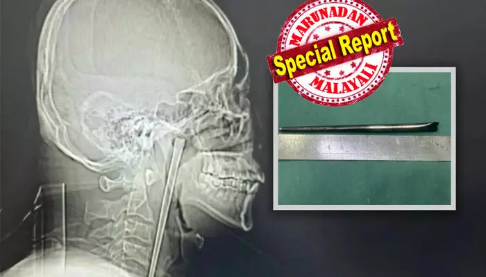 തൊണ്ടയിൽ കുടുങ്ങിയത് നല്ല നീളത്തിലുള്ള ലോഹത്തിൽ പൊതിഞ്ഞ ചോപ്സ്റ്റിക്ക്; ഒരു പേടിയുമില്ലാതെ ആ യുവാവ് ജീവിച്ചത് എട്ട് വർഷം; ഒടുവിൽ ഡോക്ടർമാരുടെ പരിശോധനയിൽ സംഭവിച്ചത് തൊണ്ടയിൽ കുടുങ്ങിയത് നല്ല നീളത്തിലുള്ള ലോഹത്തിൽ പൊതിഞ്ഞ ചോപ്സ്റ്റിക്ക്; ഒരു പേടിയുമില്ലാതെ ആ യുവാവ് ജീവിച്ചത് എട്ട് വർഷം; ഒടുവിൽ ഡോക്ടർമാരുടെ പരിശോധനയിൽ സംഭവിച്ചത്