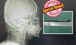 തൊണ്ടയിൽ കുടുങ്ങിയത് നല്ല നീളത്തിലുള്ള ലോഹത്തിൽ പൊതിഞ്ഞ ചോപ്സ്റ്റിക്ക്; ഒരു പേടിയുമില്ലാതെ ആ യുവാവ് ജീവിച്ചത് എട്ട് വർഷം; ഒടുവിൽ ഡോക്ടർമാരുടെ പരിശോധനയിൽ സംഭവിച്ചത്