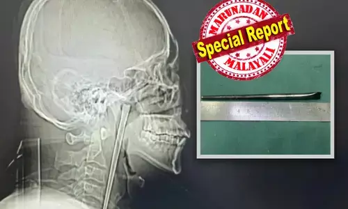 തൊണ്ടയിൽ കുടുങ്ങിയത് നല്ല നീളത്തിലുള്ള ലോഹത്തിൽ പൊതിഞ്ഞ ചോപ്സ്റ്റിക്ക്; ഒരു പേടിയുമില്ലാതെ ആ യുവാവ് ജീവിച്ചത് എട്ട് വർഷം; ഒടുവിൽ ഡോക്ടർമാരുടെ പരിശോധനയിൽ സംഭവിച്ചത്