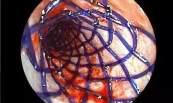 കേരളത്തില്‍ ആദ്യമായി ബയോഡീഗ്രേഡബിള്‍ എയര്‍വേ സ്റ്റെന്റിങ്; അമൃത ആശുപത്രിയില്‍ ചരിത്രനേട്ടം