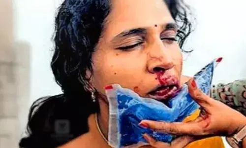 ക്ലാസില്‍ ഗെയിം കളിച്ചതിന് വഴക്കിട്ടു; അധ്യാപികയുടെ മൂക്കിന് ഇടിച്ച് വിദ്യാര്‍ത്ഥി: അടിയന്തര ശസ്ത്രക്രിയ നിര്‍ദേശിച്ച് ഡോക്ടര്‍മാര്‍